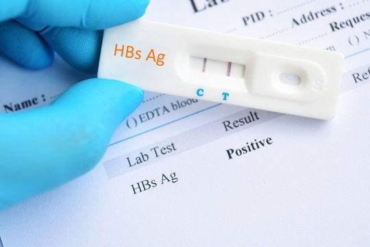 Xét nghiệm HBsAg là bước quan trọng đầu tiên để xác định sự hiện diện của virus HBV trong cơ thể.