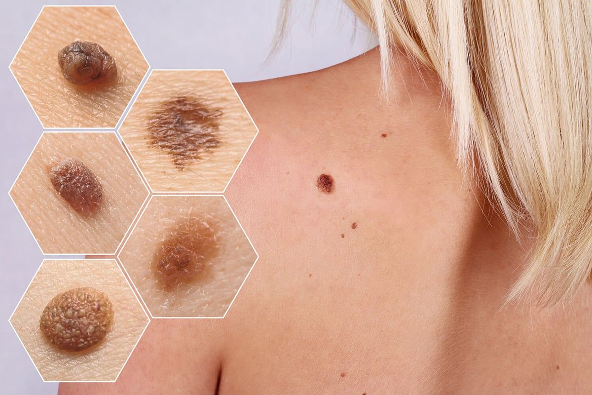 Chẩn đoán chính xác giai đoạn bệnh giúp bác sĩ đưa ra phác đồ điều trị tối ưu 