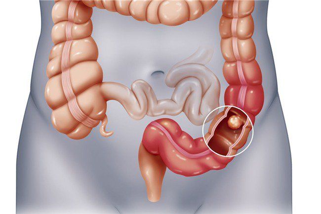 Hình minh họa khối u bất thường trong trực tràng 