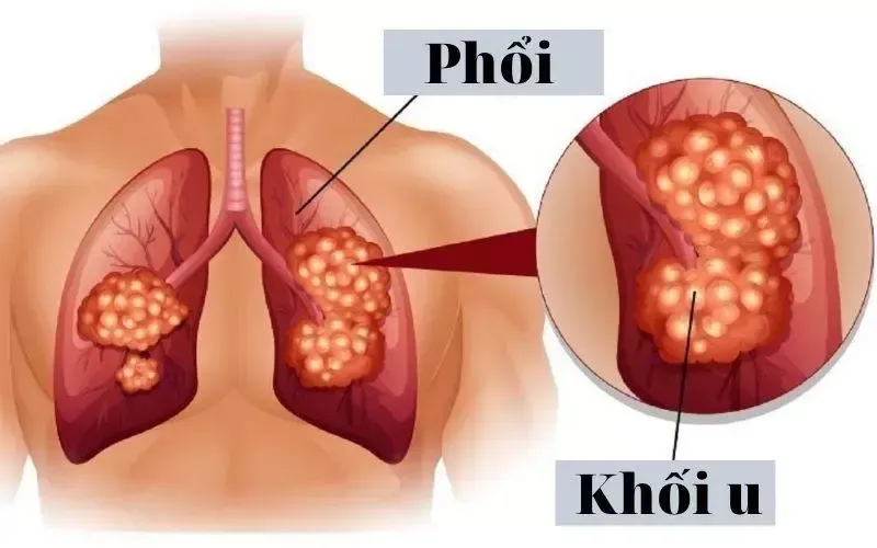 Phác đồ điều trị u phổi ác tính được cá nhân hóa chặt chẽ theo từng giai đoạn
