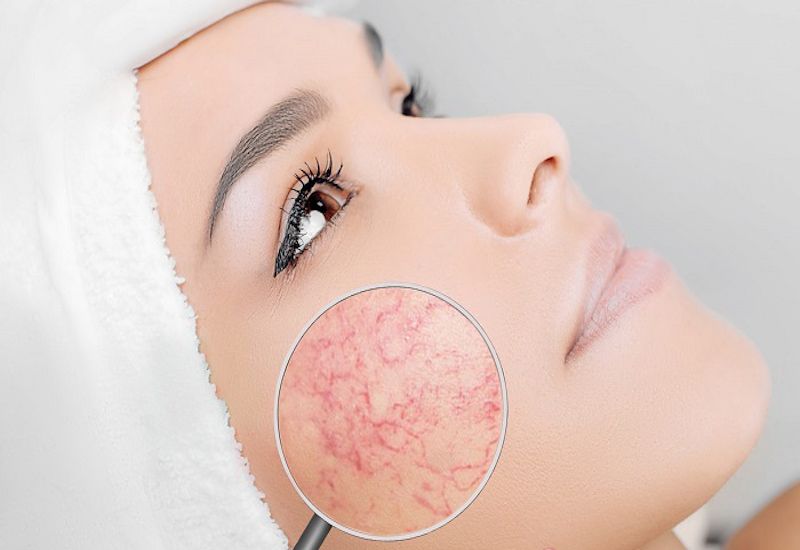 Các đường mao mạch nhỏ màu đỏ hoặc tím có thể xuất hiện rõ trên da khi bị giãn mao mạch
