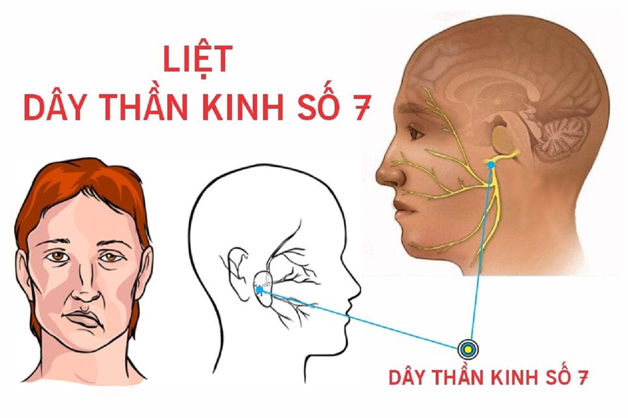 Sử dụng nước mắt nhân tạo để giữ ẩm cho giác mạc