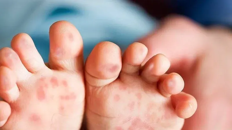 Tay chân miệng thường gây nổi mụn nước ở tay, chân và miệng