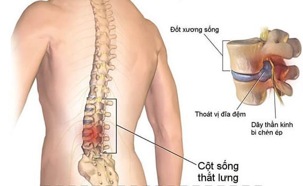 Gai cột sống ở những người bị lão hóa