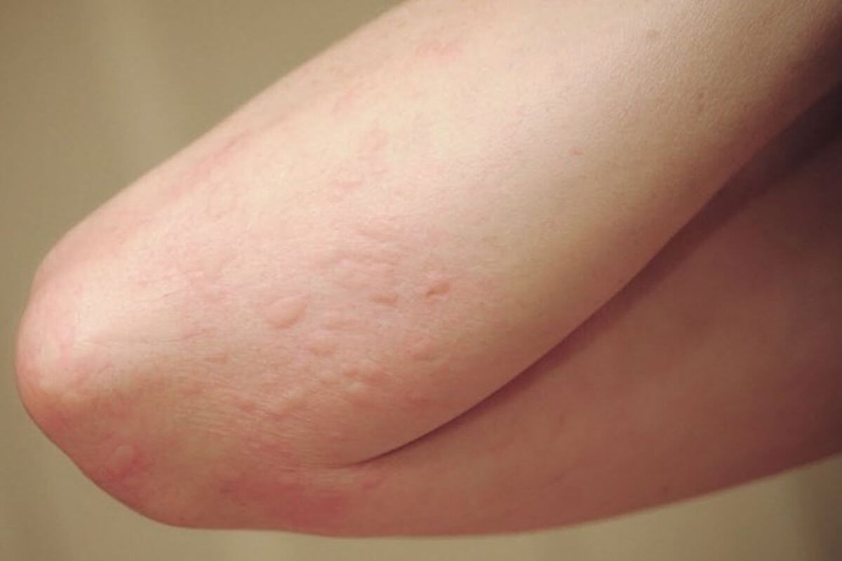 Ngứa khắp người có thể xuất hiện do nhiều nguyên nhân khác nhau từ môi trường đến bệnh lý. Nguồn: Sưu tầm