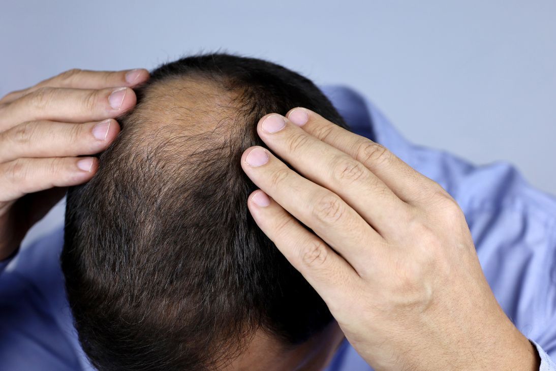 Tình trạng rụng tóc gây khoảng trống lớn trên da đầu