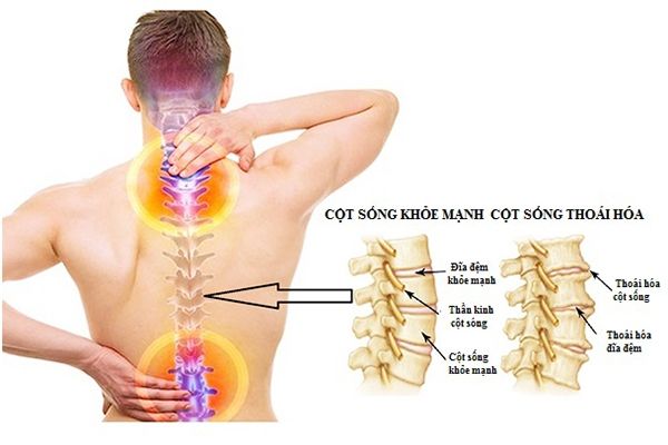 Thoái hóa cột sống 