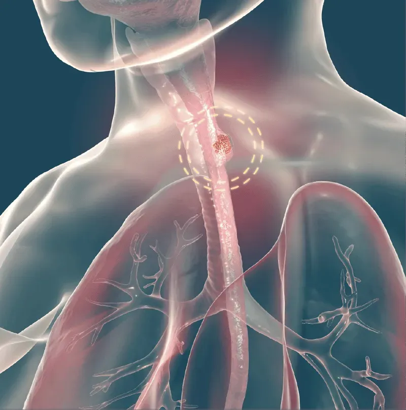 Phác đồ điều trị được cá nhân hóa giúp nâng cao cơ hội hồi phục cho bệnh nhân ung thư thực quản 