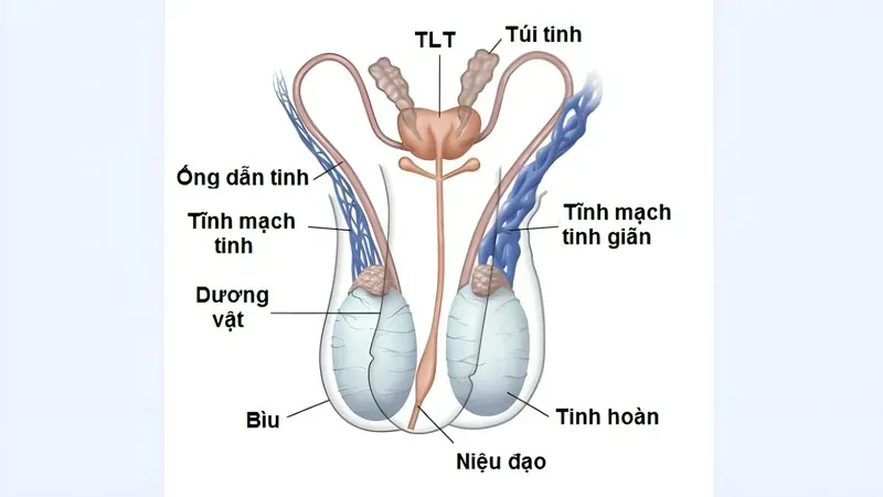 Giãn tĩnh mạch thừng tinh xảy ra khi các tĩnh mạch trong bìu bị giãn và xoắn