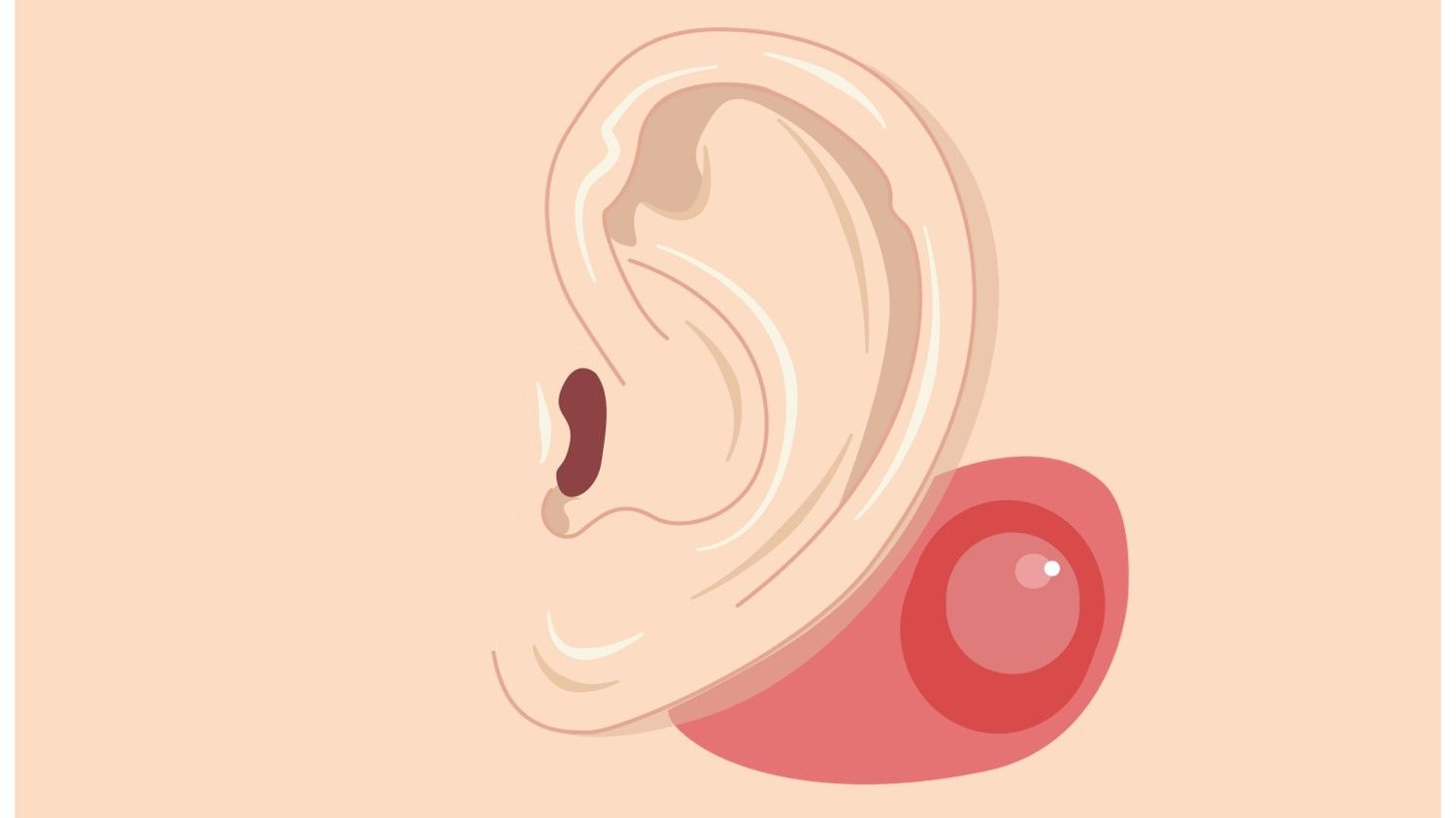 Triệu chứng chảy mủ tai kéo dài kèm mùi hôi là dấu hiệu báo động viêm xương chũm nguy hiểm 