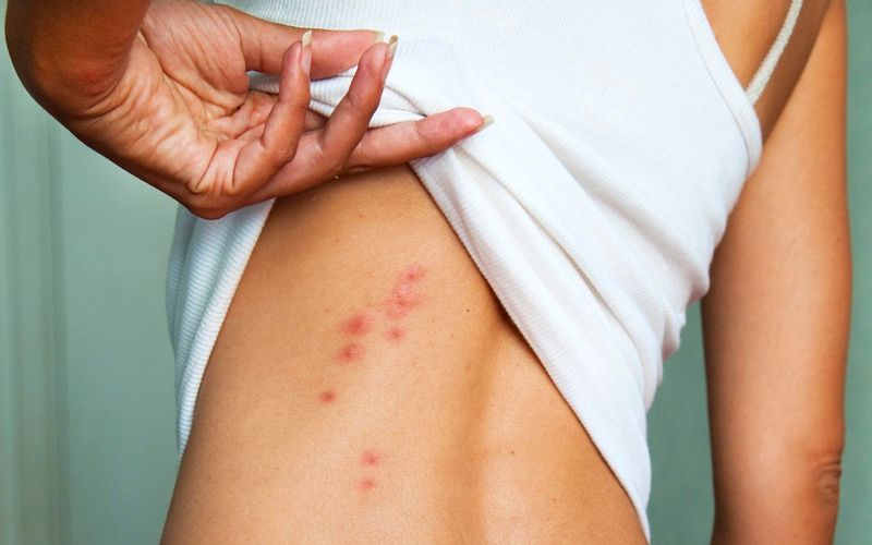 Sẩn ngứa do gan thường biểu hiện qua các nốt mẩn đỏ gây khó chịu trên diện rộng