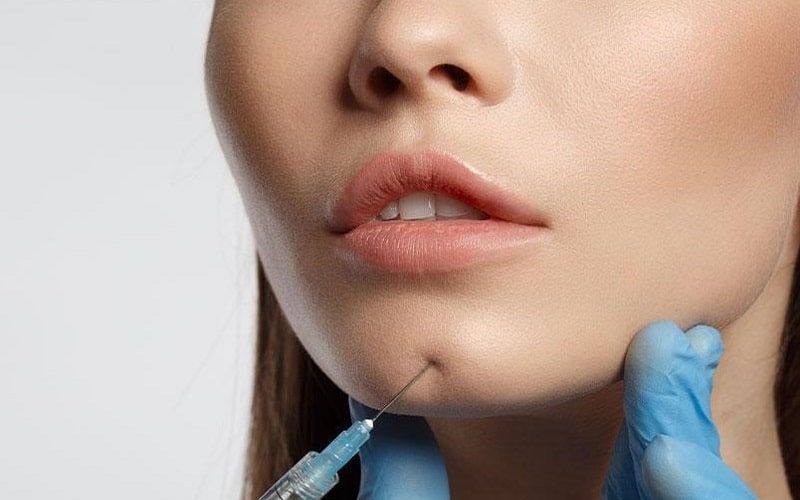 Sưng, đỏ nhẹ và cảm giác căng tức là những biểu hiện thường gặp sau khi tiêm tan filler.