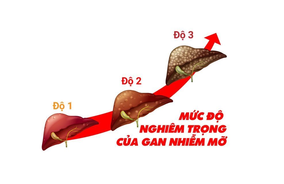 Siêu âm định kỳ giúp phát hiện gan nhiễm mỡ độ 1 kịp thời 