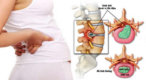 Minh hoạ về vị trí đau do thoát vị đĩa đệm gây nên