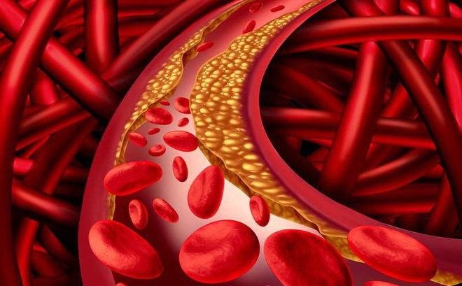 Mỡ máu cao là nguyên nhân trực tiếp dẫn đến xơ vữa mạch máu và đột quỵ 