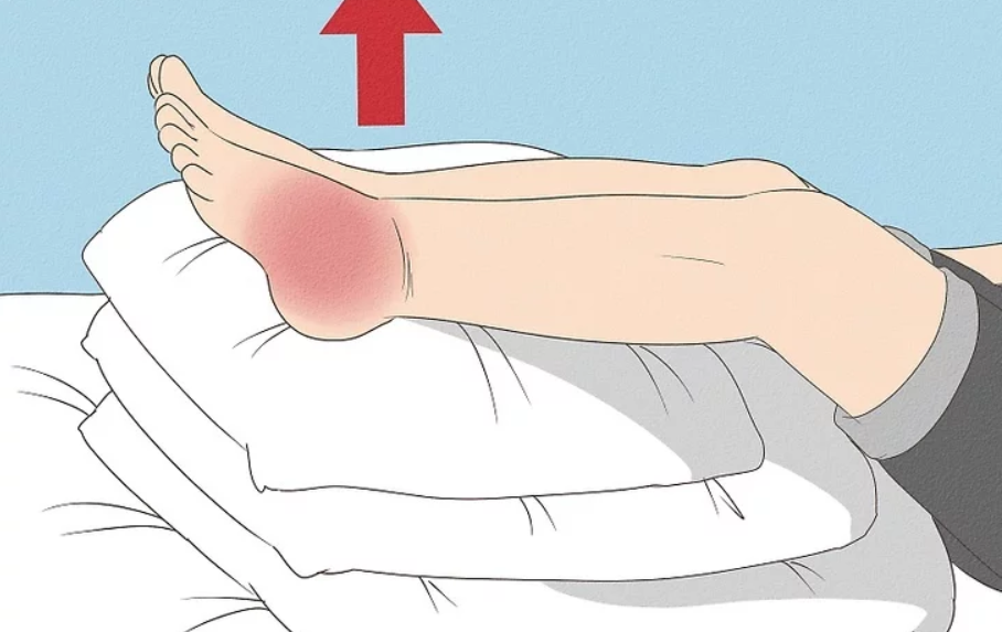 Sưng nề và bầm tím là dấu hiệu điển hình của tình trạng trẹo chân mức độ trung bình 