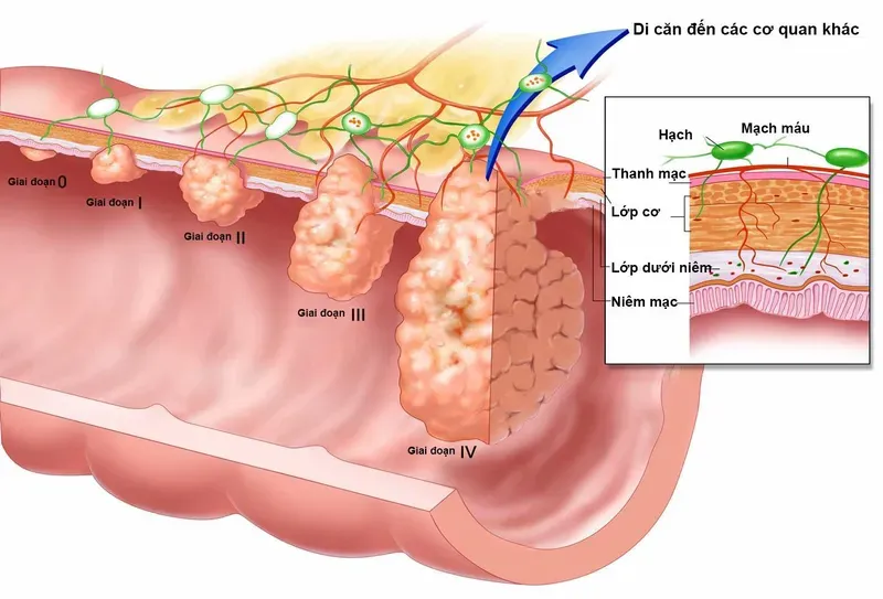 Sự thấu hiểu về giai đoạn bệnh giúp bệnh nhân có hướng điều trị tích cực ngay từ đầu 