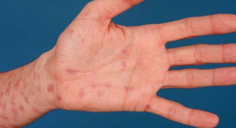 Nút lưỡi thông thường có nguy cơ lây nhiễm HIV cực kỳ thấp nhờ cơ chế bảo vệ của nước bọt