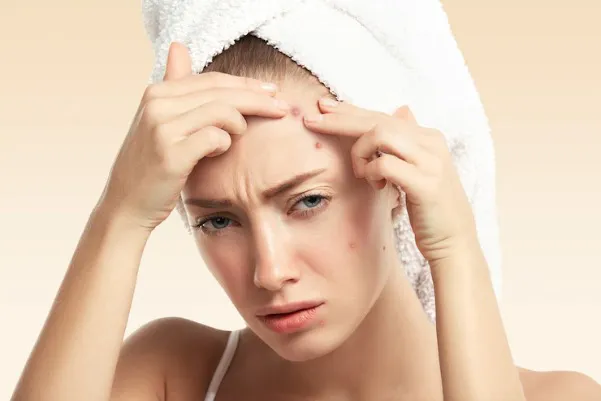 Hình ảnh minh họa các ổ mụn viêm liên kết với nhau tạo thành nang cục lớn dưới bề mặt da