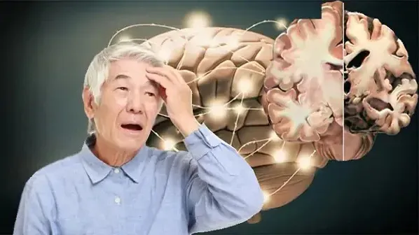 Bệnh Alzheimer 