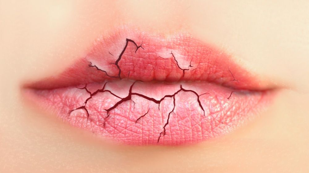 Tình trạng khô môi gây đau rát và ảnh hưởng đáng kể đến thẩm mỹ khuôn mặt 