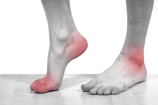 Triệu chứng sưng đỏ điển hình tại khớp ngón chân cái thường gặp ở bệnh gút 