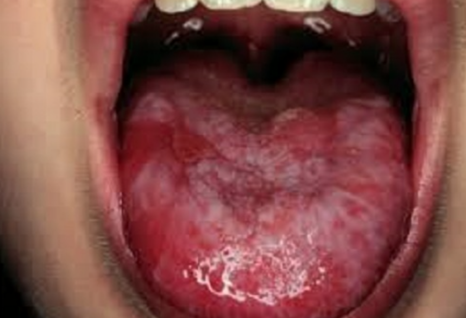Hình minh họa chăm sóc bệnh nhân điều trị ung thư