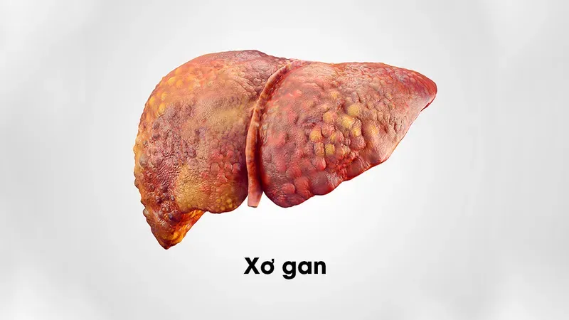 Xơ gan không lây qua các tiếp xúc xã hội thông thường như giao tiếp hàng ngày