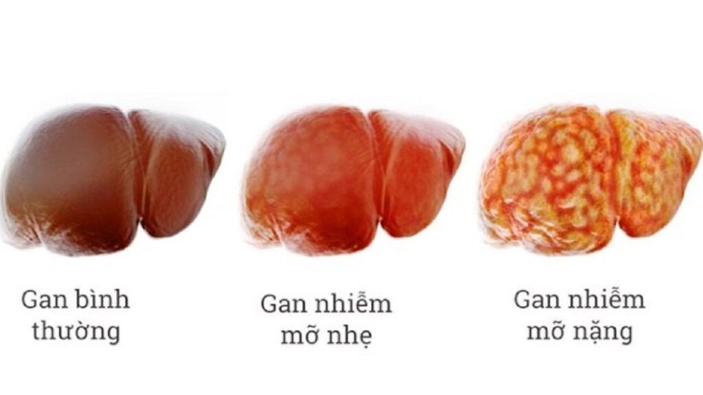 Hiểu rõ nguyên nhân giúp ngăn chặn gan nhiễm mỡ độ 3 tiến triển rạng rỡ và bền bỉ 