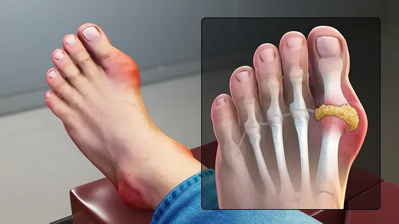 Cơn đau gút cấp tính thường tấn công khớp ngón chân cái gây sưng đỏ dữ dội 