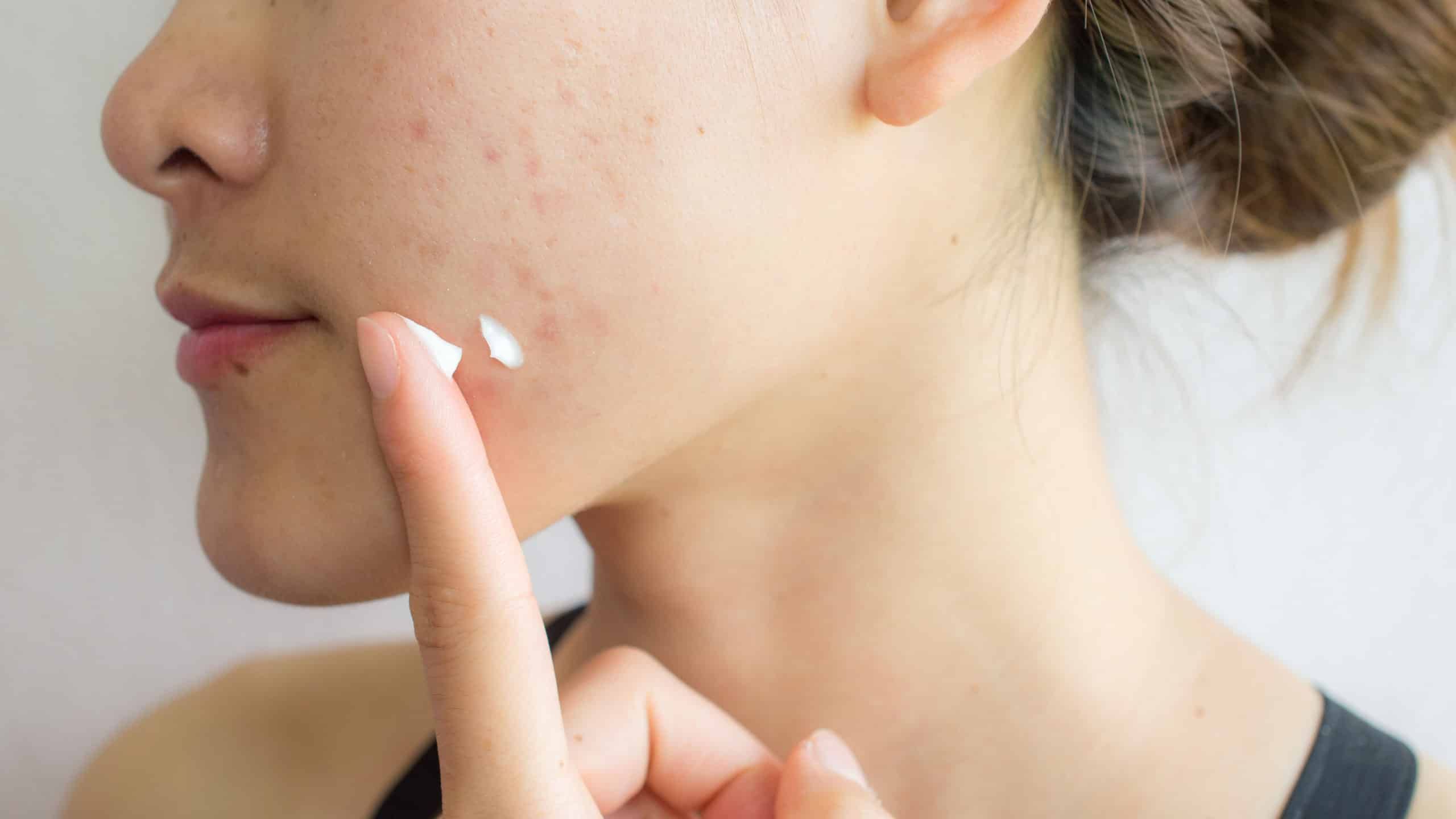 Tuân thủ liều lượng bôi giúp bảo vệ hàng rào bảo vệ tự nhiên của da