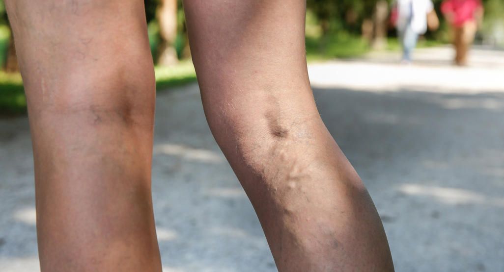 Hình minh họa tĩnh mạch chân bị giãn và nổi rõ dưới da