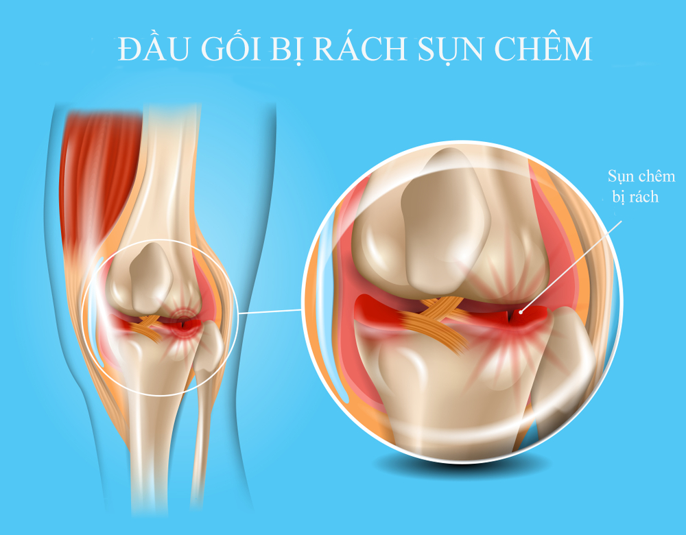 Sụn chêm là cấu trúc sụn nằm giữa xương đùi và xương chày trong khớp gối