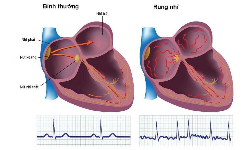 Một số hình ảnh mô tả về nhịp tim bất thường của người có vấn đề tim mạch