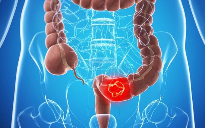 Các yếu tố ảnh hưởng đến tiên lượng ung thư đại tràng di căn