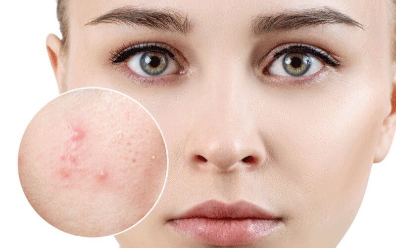 Hiện tượng bong tróc nhẹ hoặc đẩy mụn ẩn là phản ứng thích nghi bình thường của da khi mới dùng Retinal