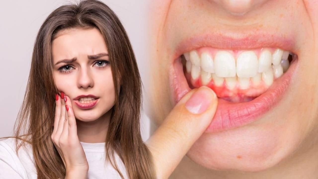 Viêm nướu là một trong những nguyên nhân phổ biến gây chảy máu chân răng