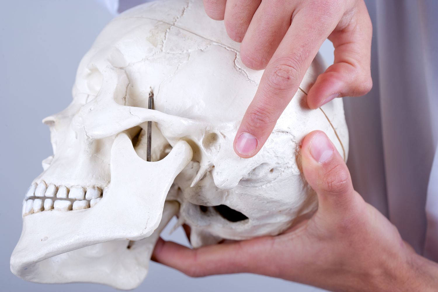 Cholesteatoma là một khối túi biểu mô nằm sai vị trí trong tai giữa, có khả năng tàn phá các xương nhỏ dẫn truyền âm thanh