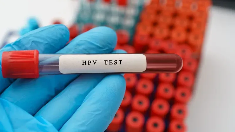 Xét nghiệm HPV test là phương pháp quan trọng để xác định virus gây bệnh 