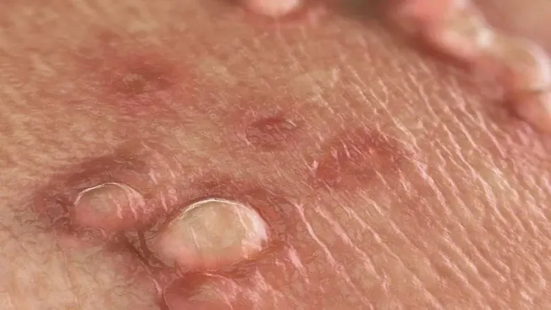 Mụn nhỏ xuất hiện trên dương vật có thể do viêm nang lông hoặc kích ứng da.