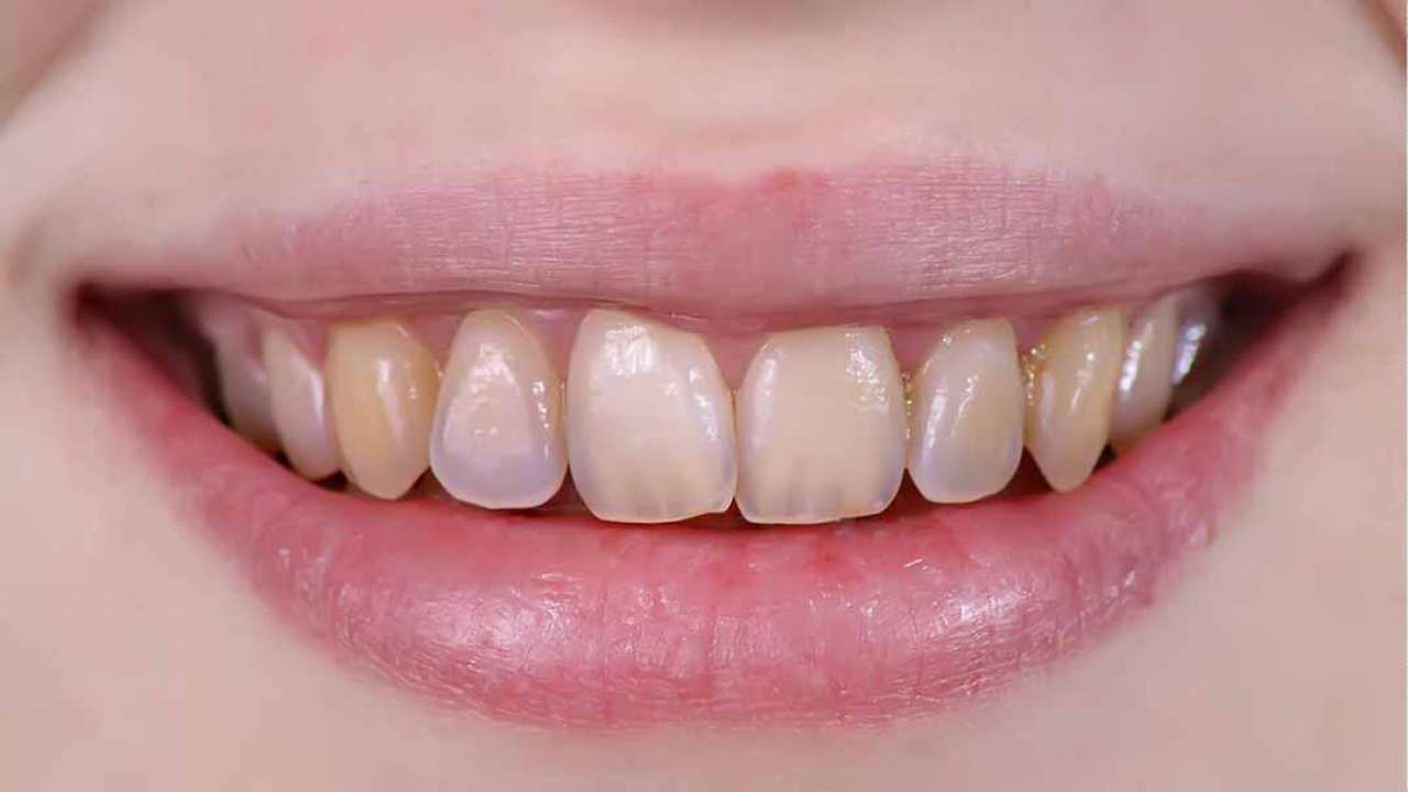 Sử dụng đúng hàm lượng khuyến cáo giúp ngăn ngừa hội chứng nhiễm fluor gây tổn hại men răng của trẻ 