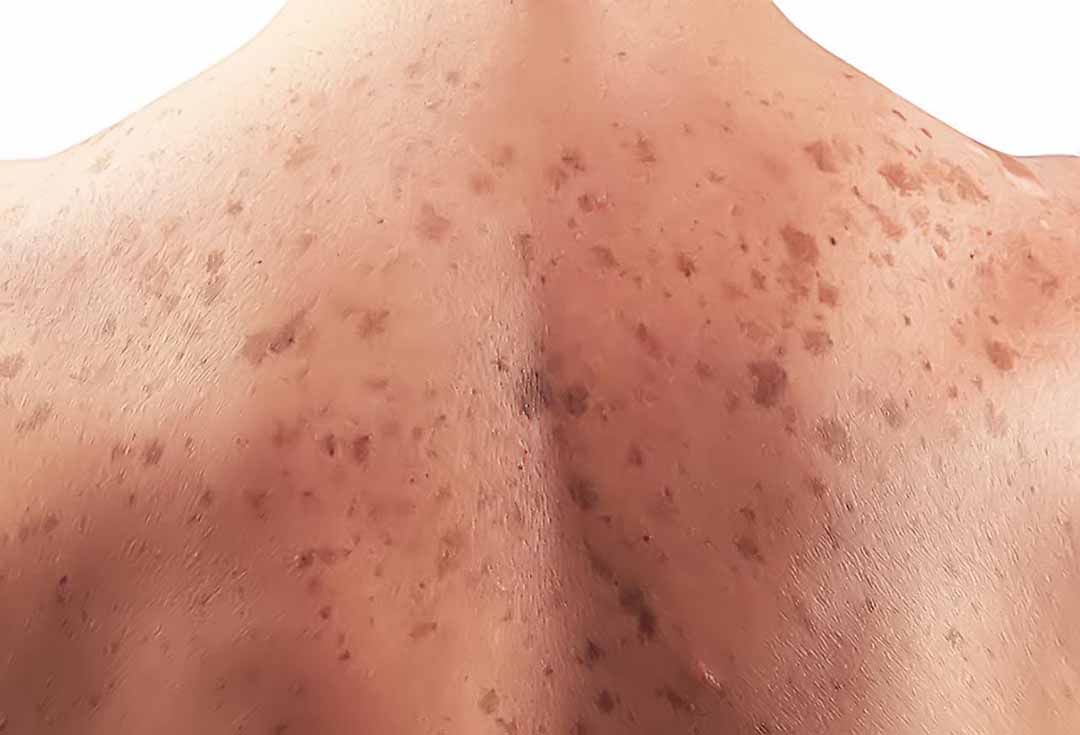 Phát hiện sớm là yếu tố tiên quyết giúp nâng cao tỷ lệ sống sót 