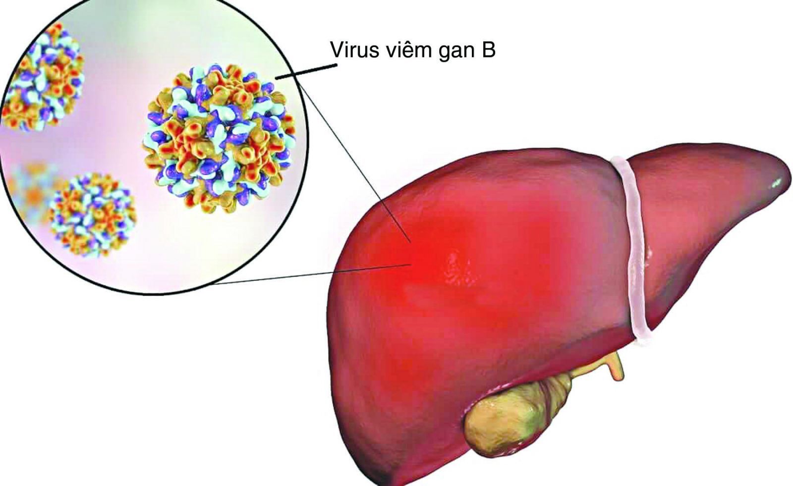 Minh hoạ về tế bào gan khi bị mắc viêm gan B
