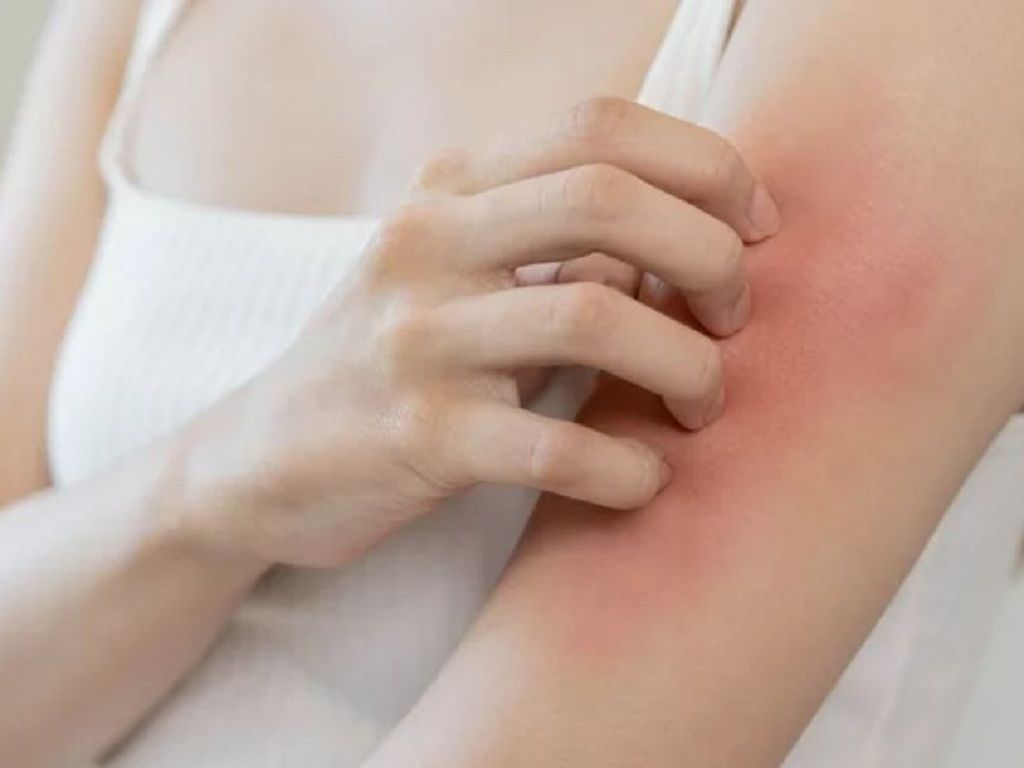 Muối biển có đặc tính sát khuẩn tự nhiên giúp giảm sưng phù và ngứa ngáy do mề đay