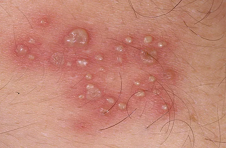 Viêm da tiếp xúc dị ứng có thể gây nổi cục giống muỗi đốt