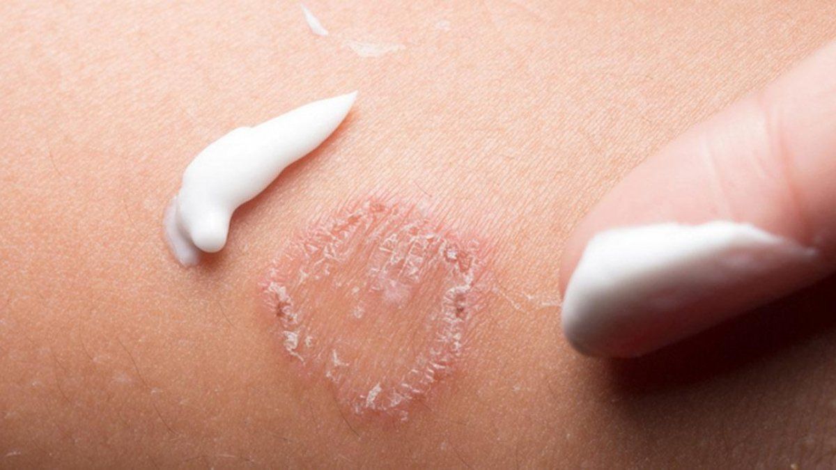 Minh hoạ về sử dụng kem bôi trong một số trường hợp
