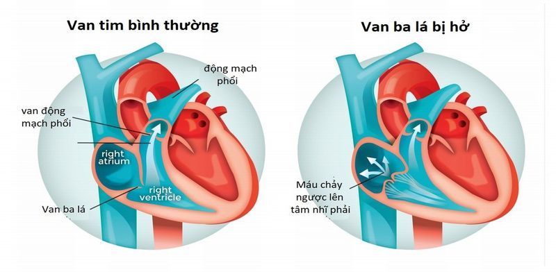 Hở van động mạch phổi 1/4 thường được coi là tình trạng sinh lý bình thường ở nhiều người khỏe mạnh 