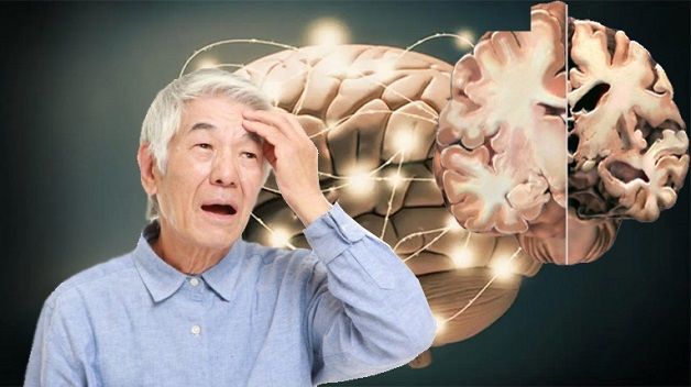 Giảm trí nhớ là triệu chứng đầu tiên của bệnh Alzheimer