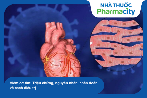 Viêm cơ tim: Triệu chứng, nguyên nhân, chẩn đoán và cách điều trị
