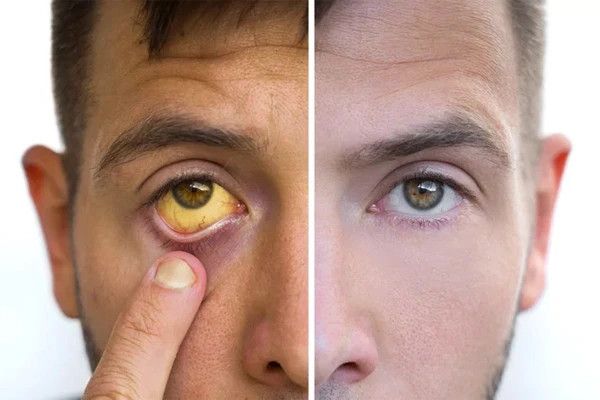 Triệu chứng điển hình của bệnh gan